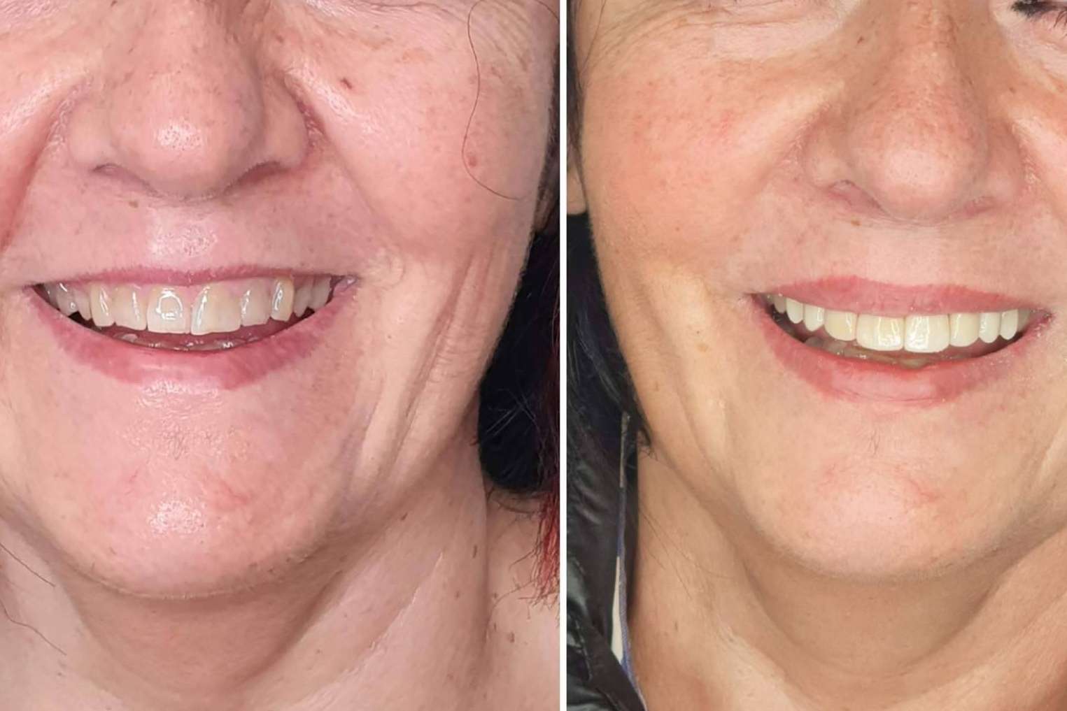 Dentinova, la opción para conseguir una sonrisa Hollywood