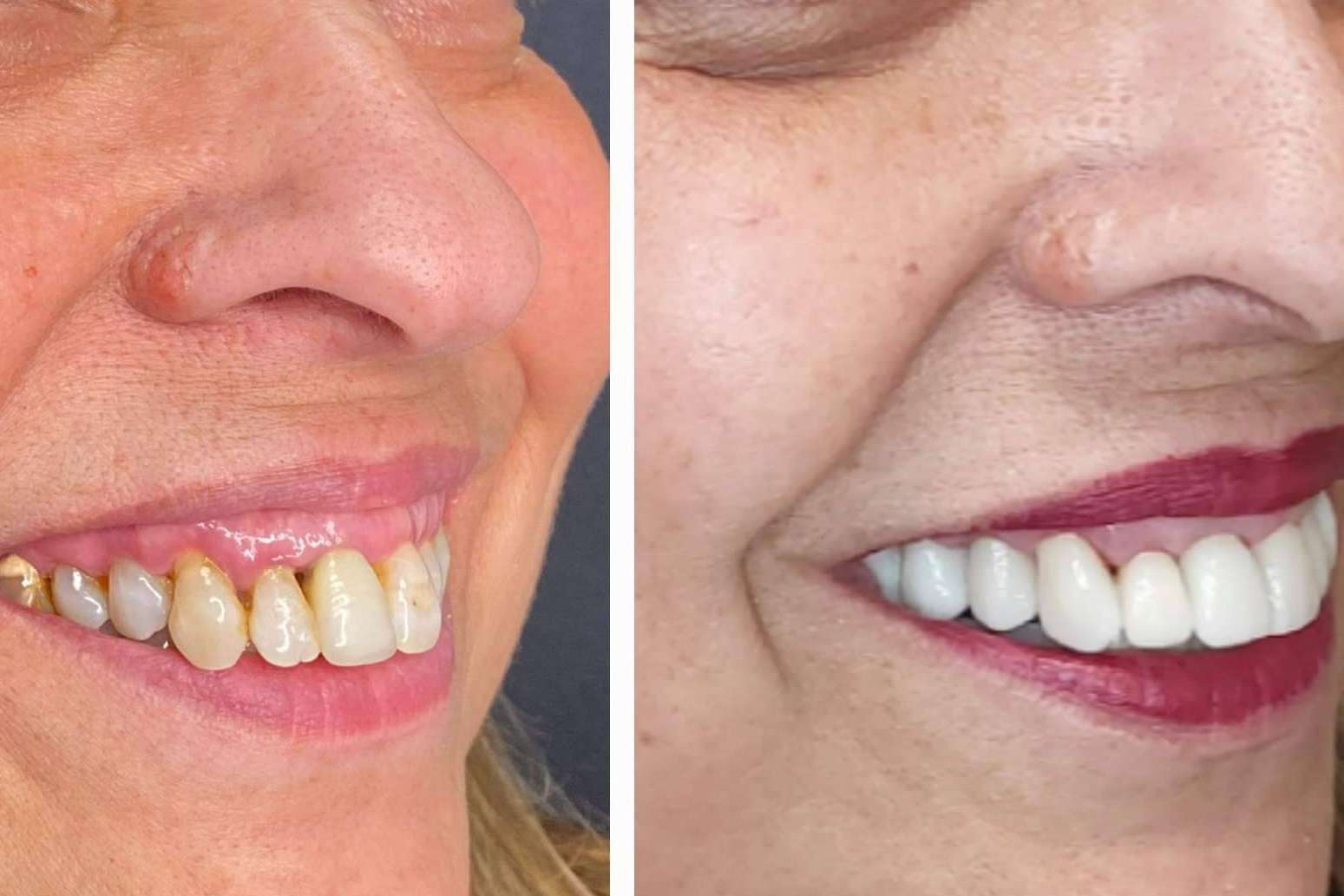 Todo lo que hay que saber acerca de las carillas dentales, por Dentinova