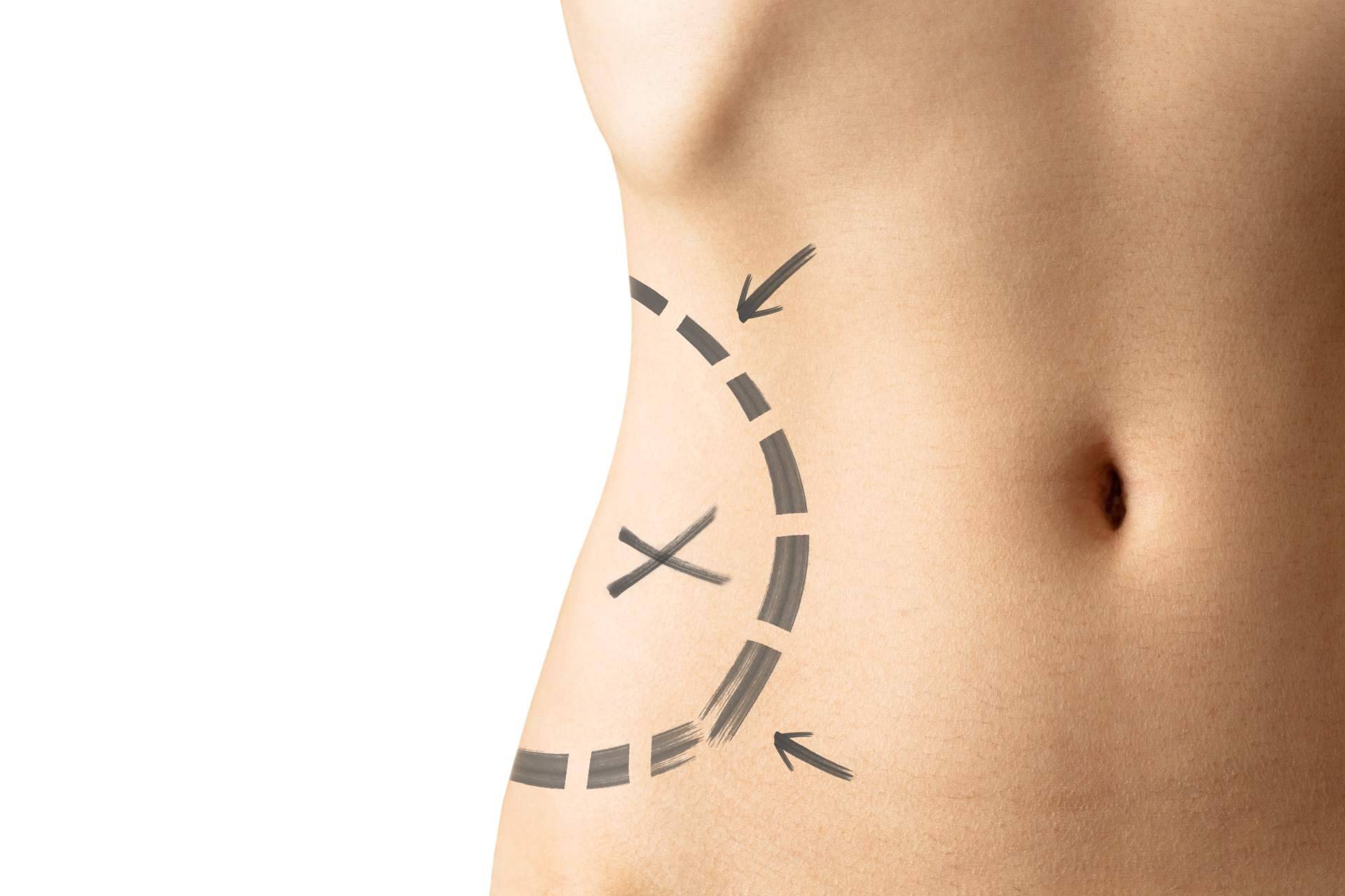 A2Clínic sobre los beneficios de la lipoescultura
