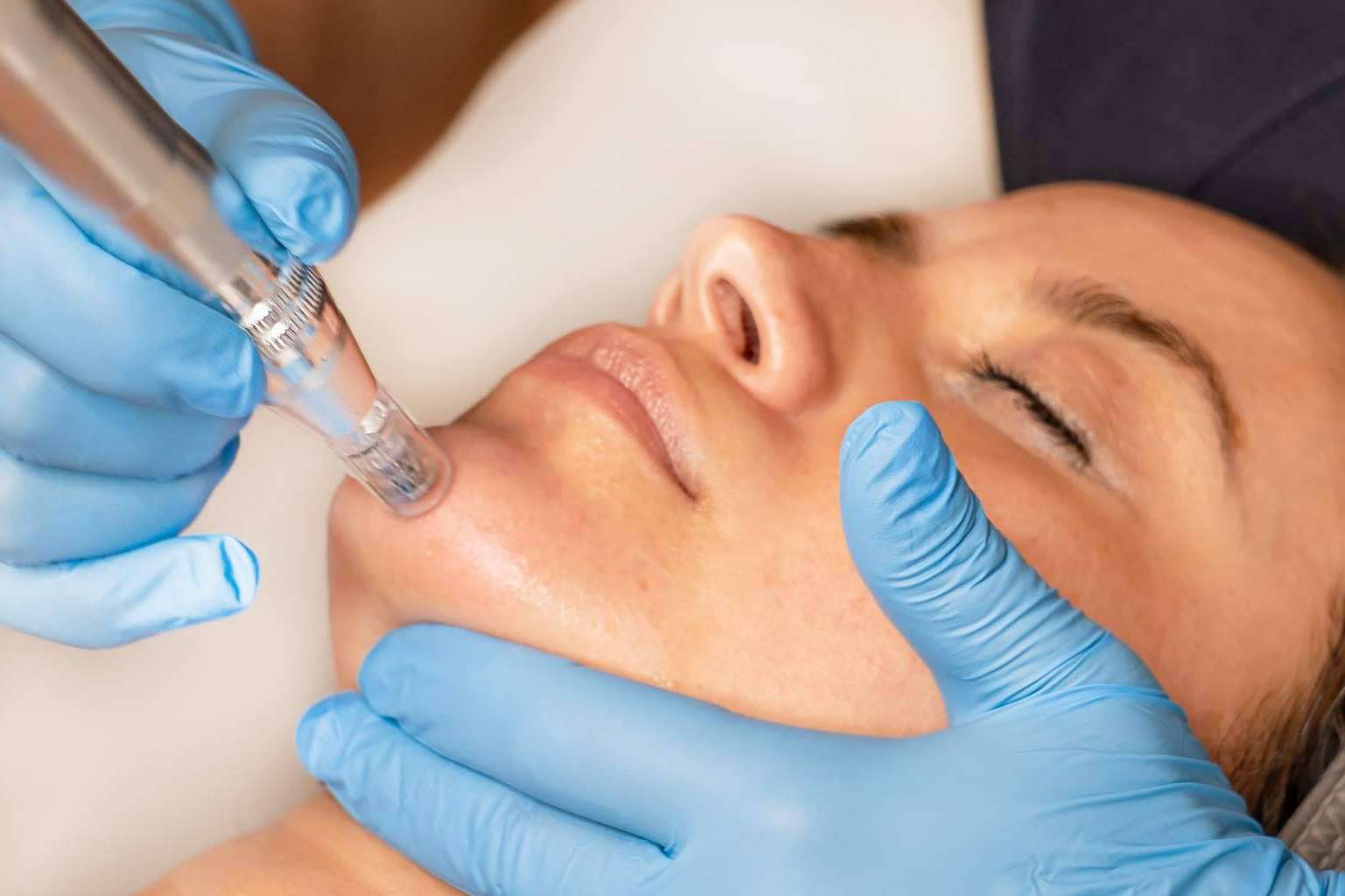 G&G Beauty ofrece un tratamiento innovador Dermapen Madrid