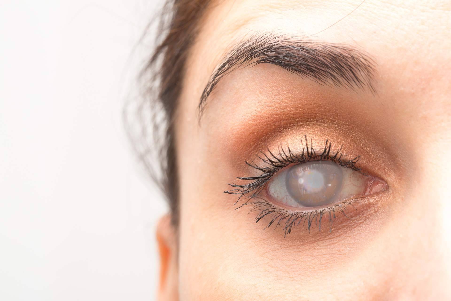 El empleo de lentes intraoculares para tratar las cataratas