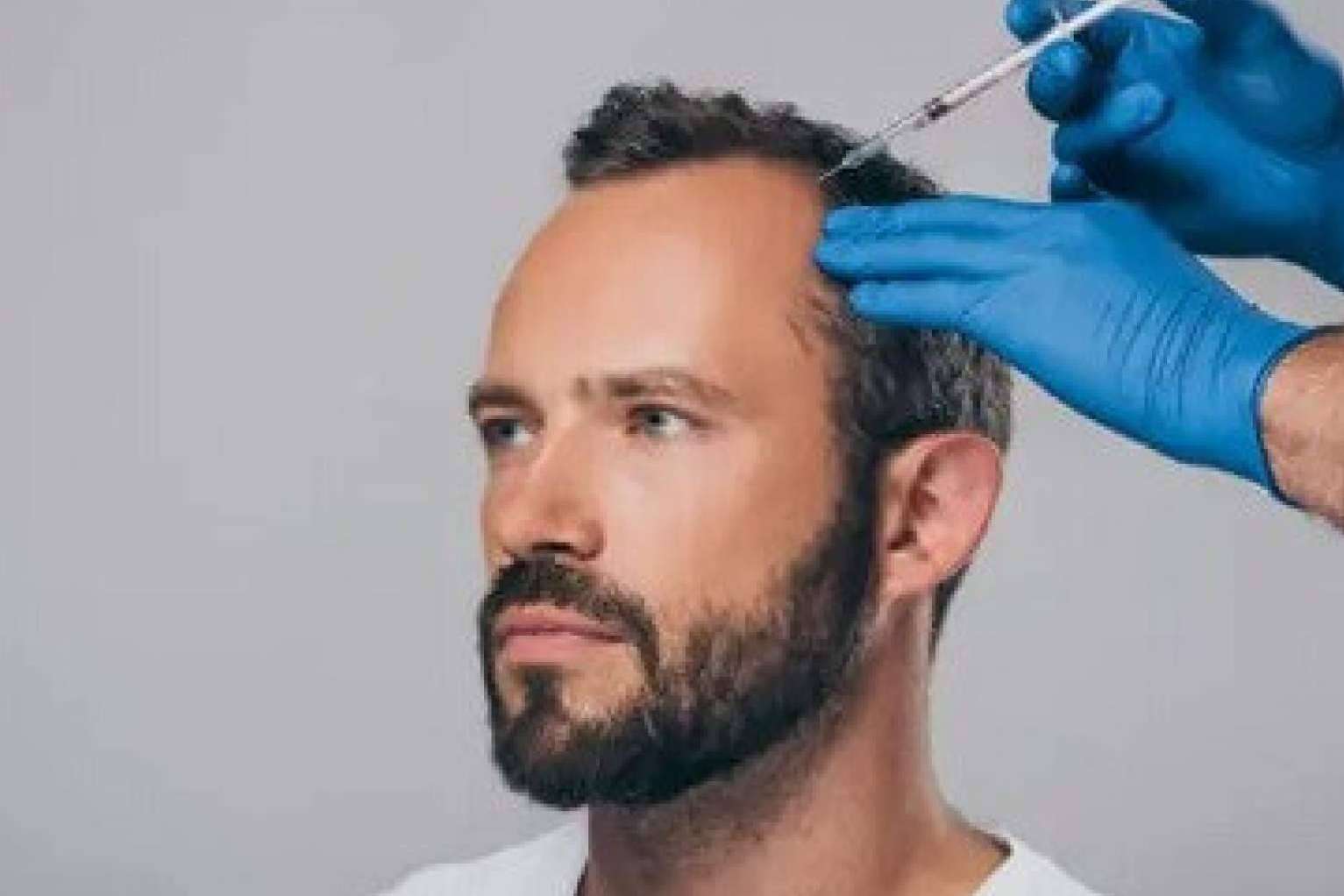 La mesoterapia capilar es un tratamiento para la caída del pelo