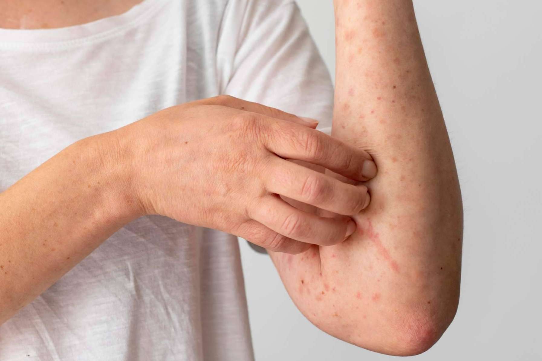 Los luchadores contra el eczema ahora tienen un superhéroe, Novopiel