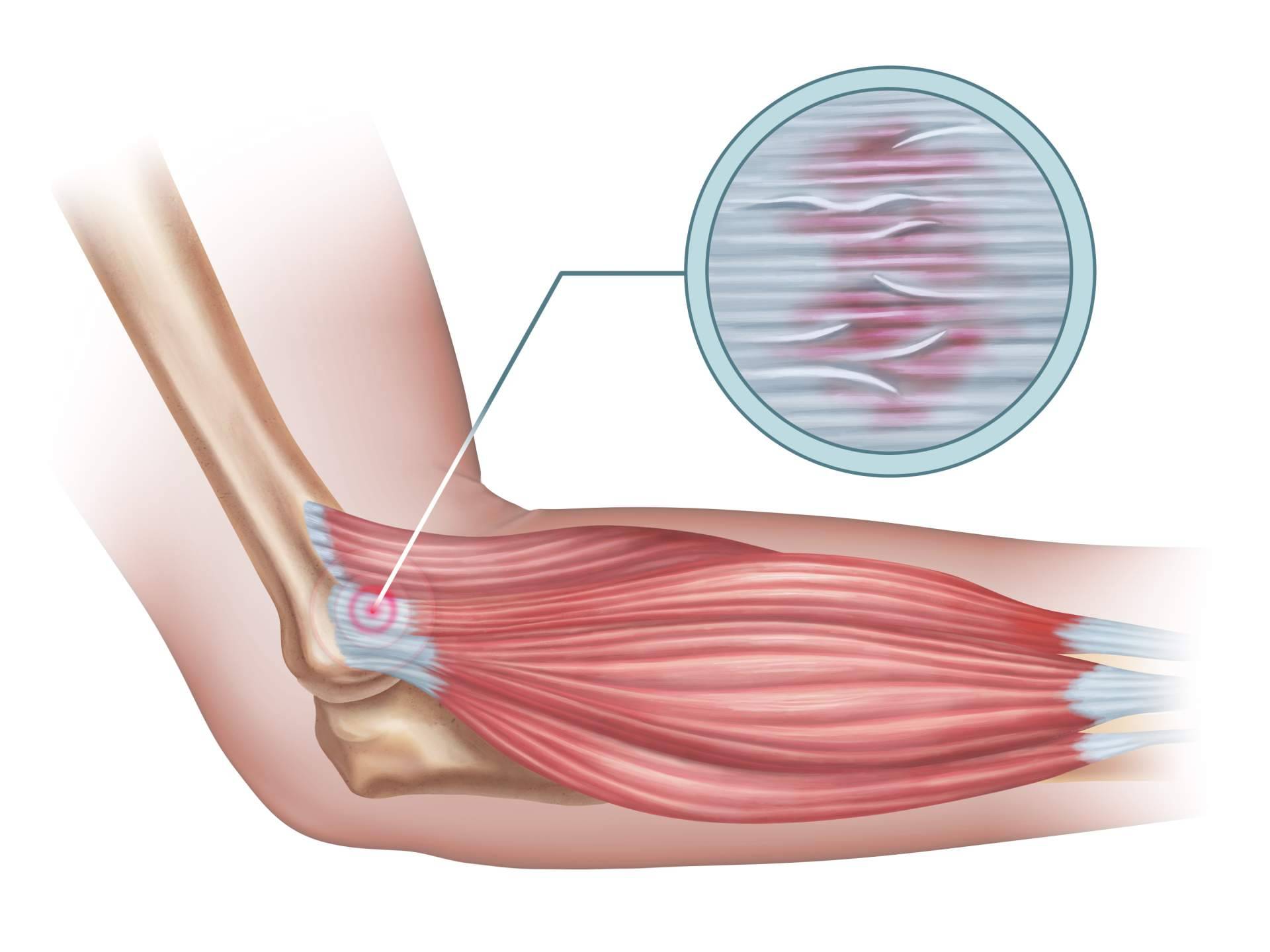 Ttendinitis con entrenamiento de fuerza, qué es y cómo mejorarla