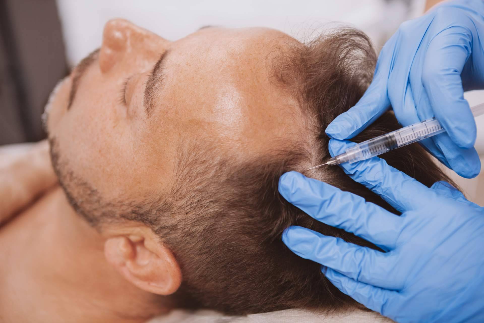 Tratamiento de la alopecia androgenética con exosomas, de la mano de Alluring Clinic