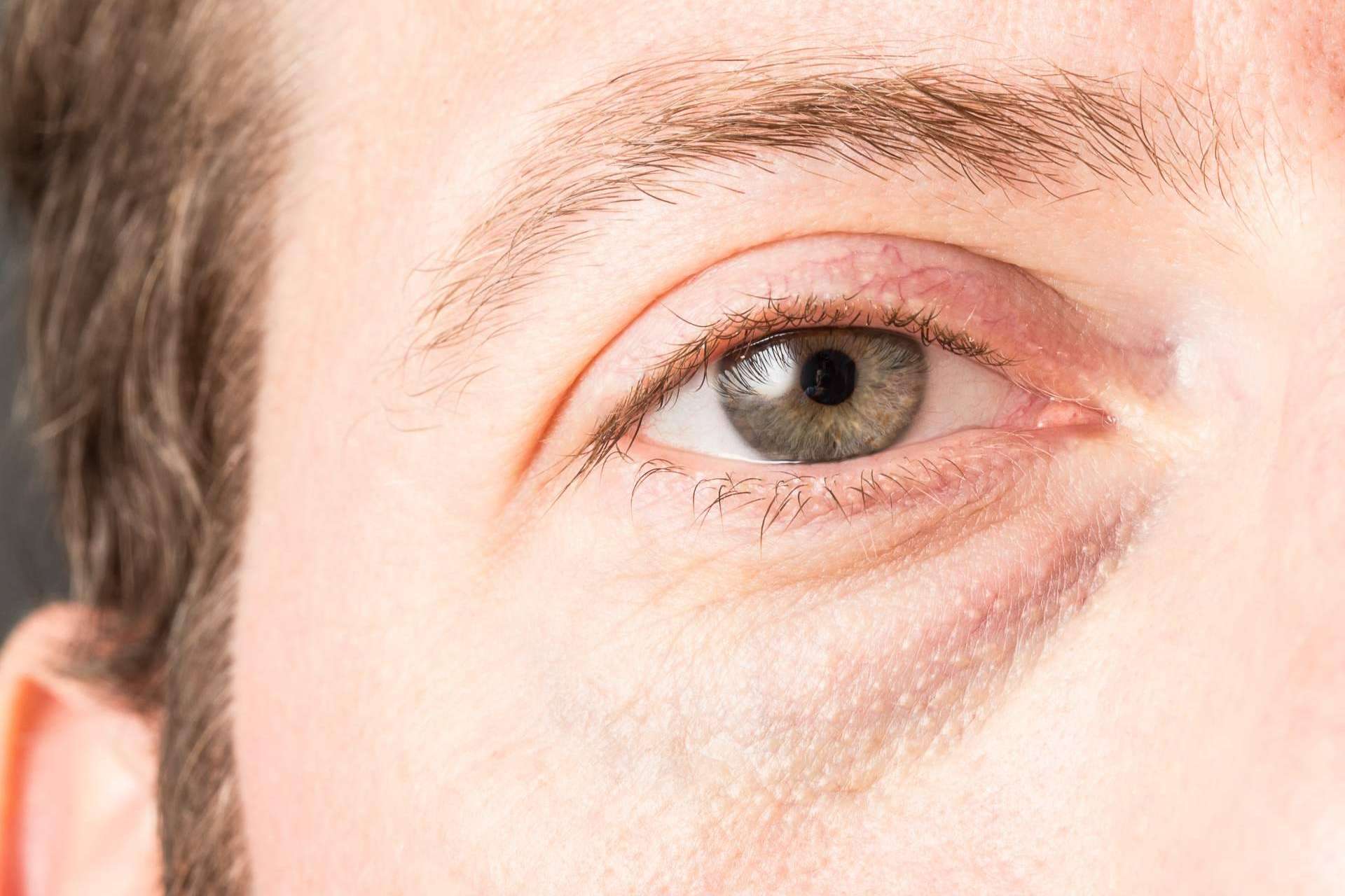 Adiós a las ojeras con el tratamiento Banzeye
