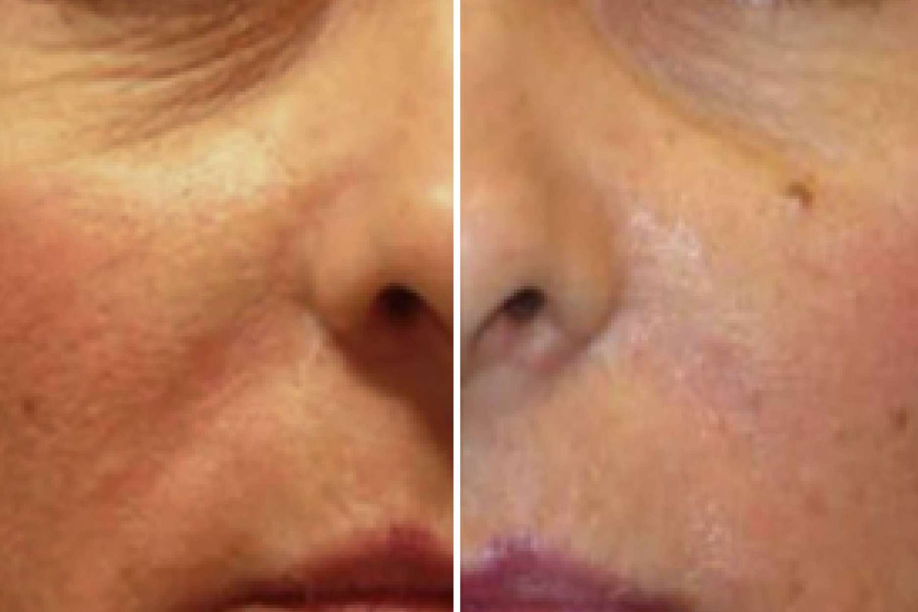 ¿Dónde es posible realizar el tratamiento Retargeting facial RENOPHASE?