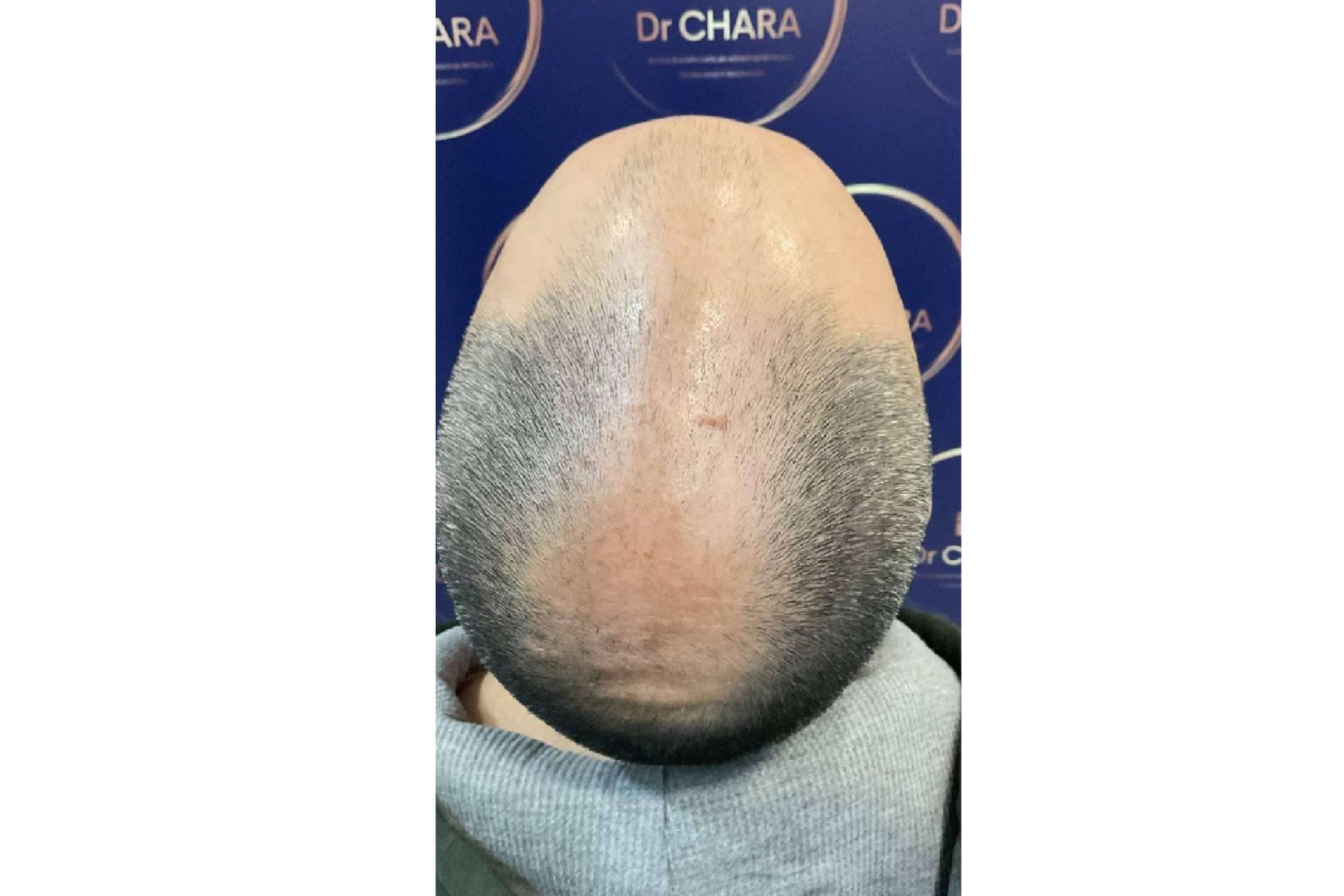 El Dr. Chara, un especialista en injerto capilar en Barcelona  y otros tratamientos para la alopecia