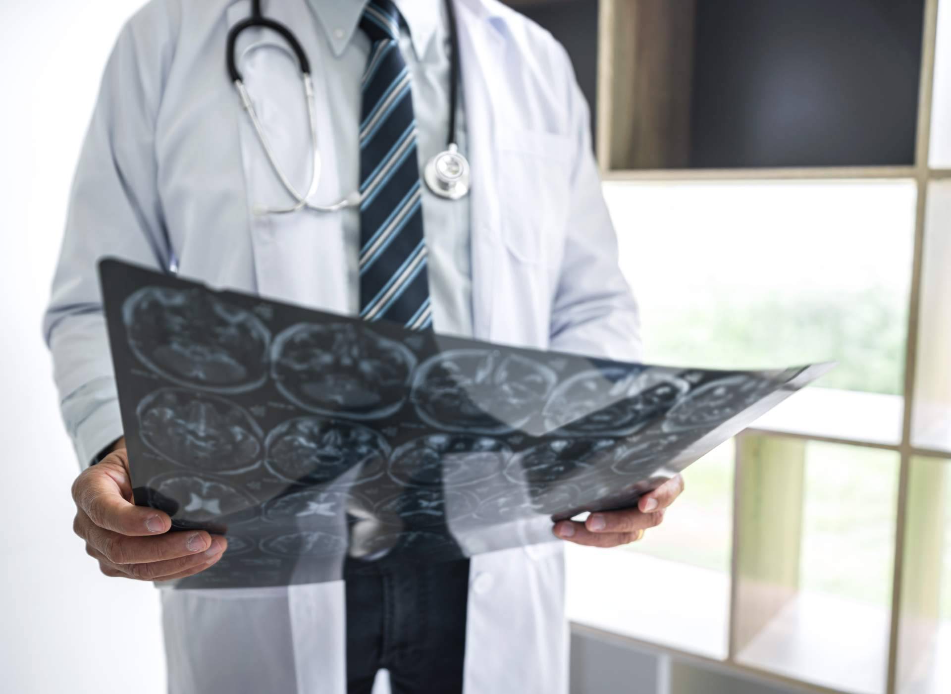 Tratamientos sin fármacos para el alzheimer con Inmunoterapia