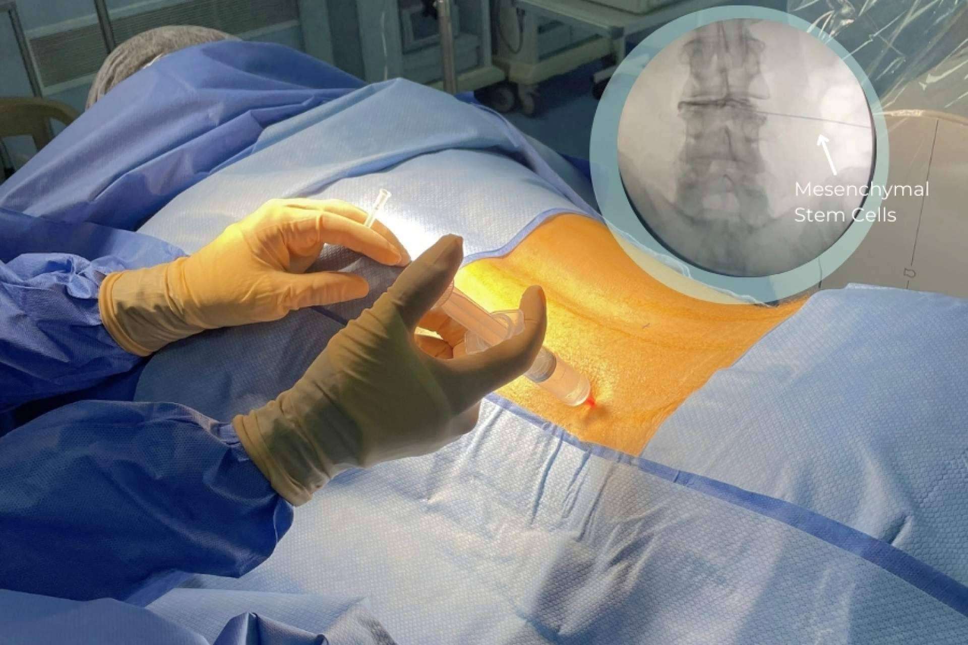 El tratamiento de células madre de Immunotherapy Regenerative Medicine ofrece un alivio eficaz y duradero para la hernia de disco