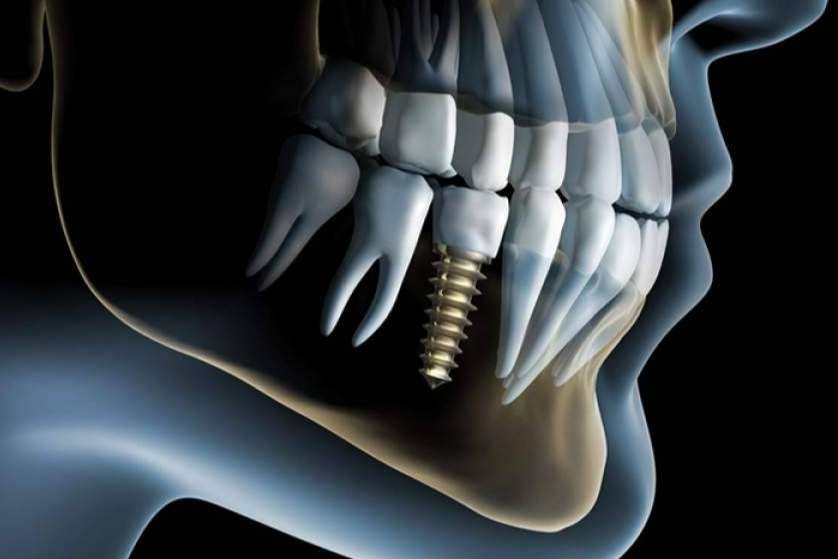 Implantología oral y rehabilitación; La práctica especializada del Dr. Heitmar Sarmiento