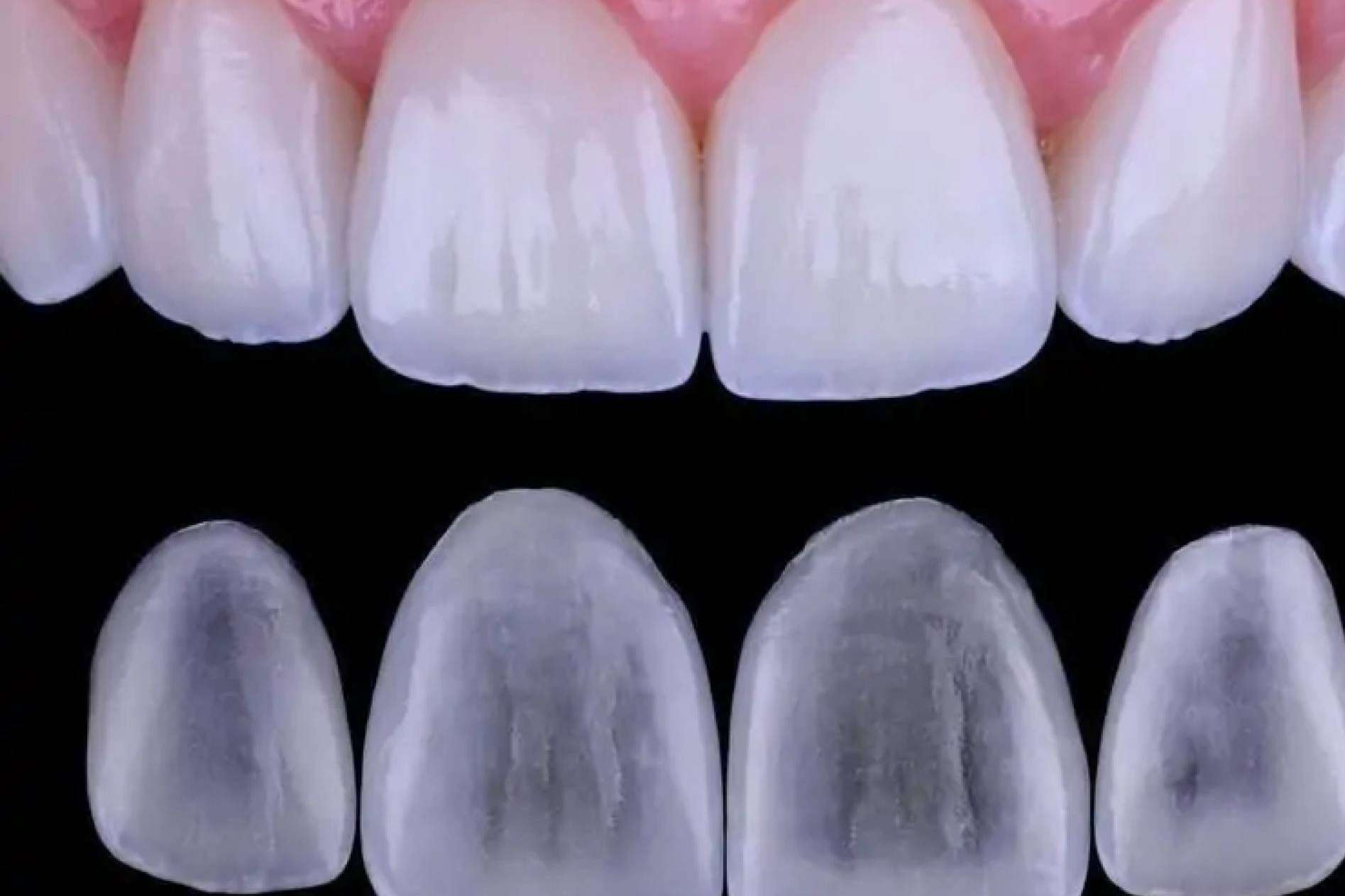 Una nueva sonrisa con carillas de cerámica