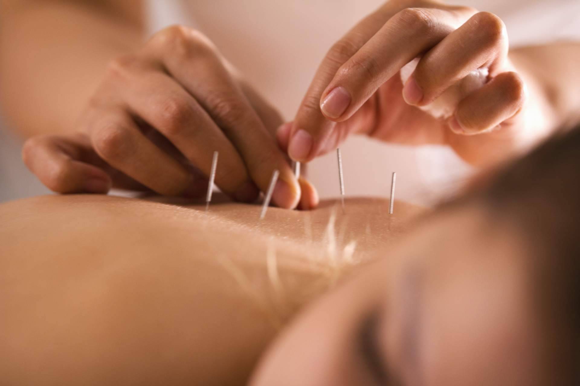 Tratamientos personalizados de acupuntura en Málaga de la mano de Vital Balance