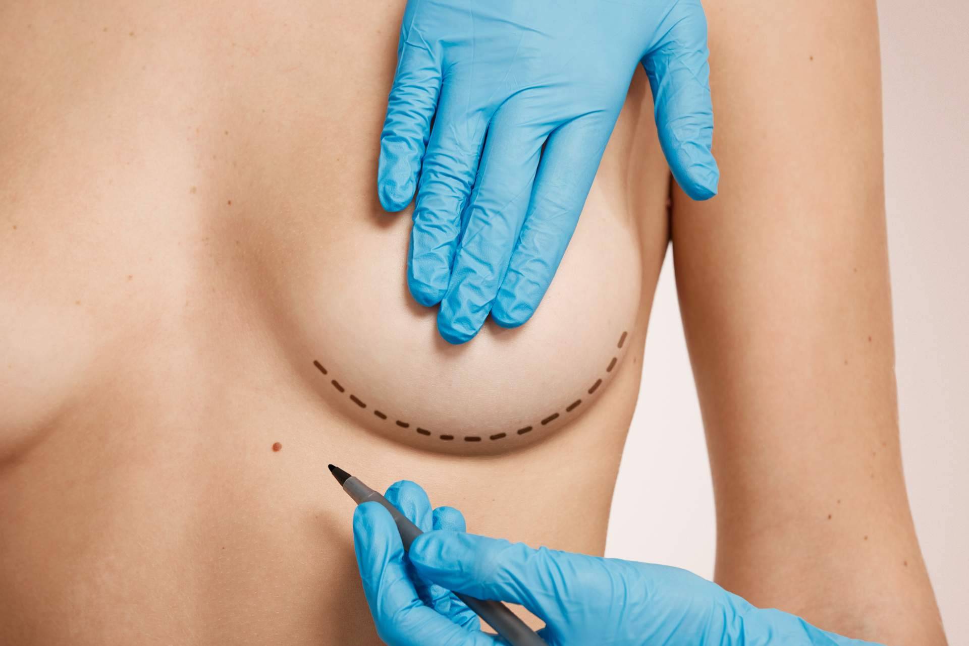 Cirugía de elevación de pecho o mastopexia, la especialidad de Beauty&Beauty