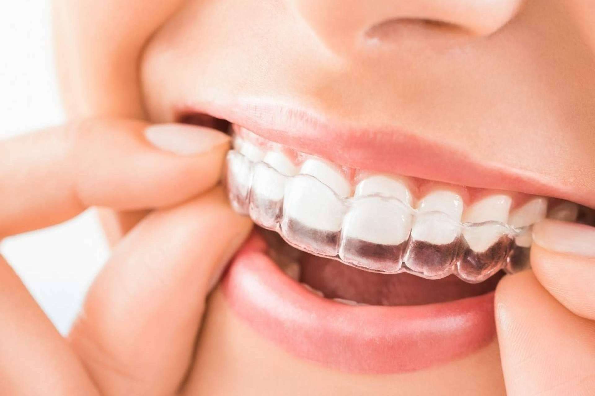 Custom Dental presenta la ortodoncia invisible como la opción innovadora para una sonrisa perfecta