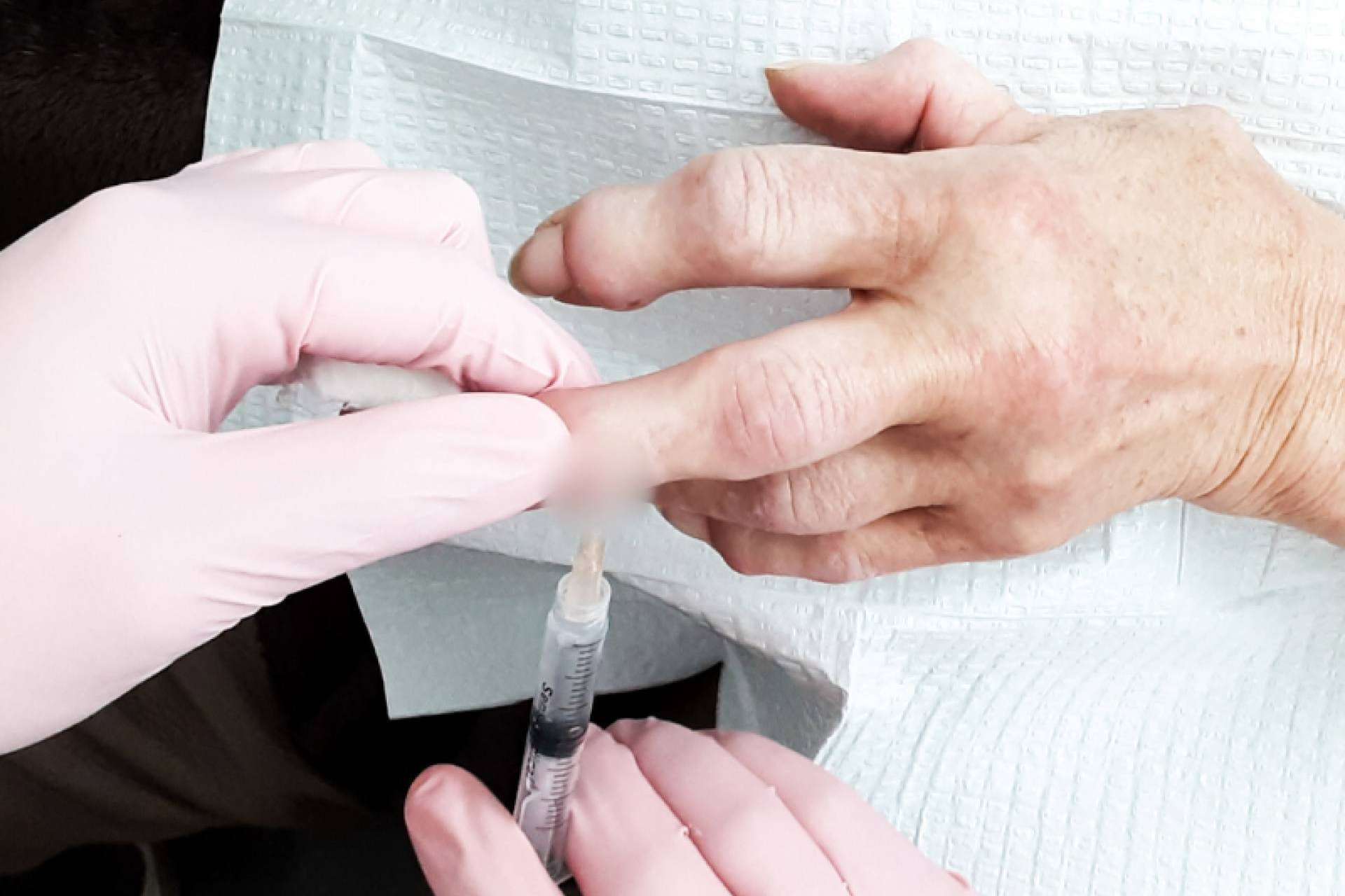 La historia de una paciente con artritis reumatoide tratada con células madre en Immunotherapy Regenerative Medicine