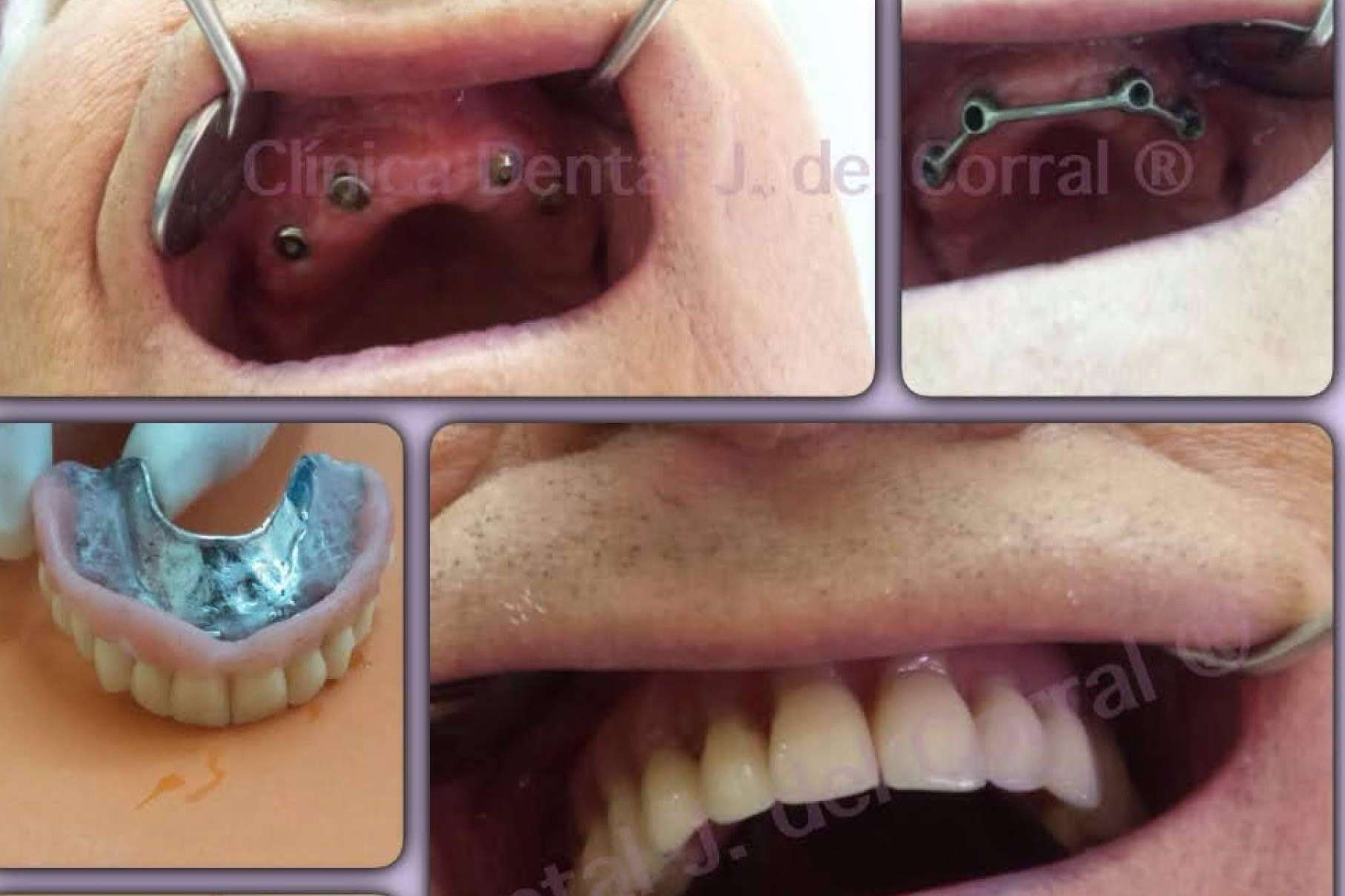 Madrid confía en Clínica Jorge del Corral para implantes dentales de excelencia