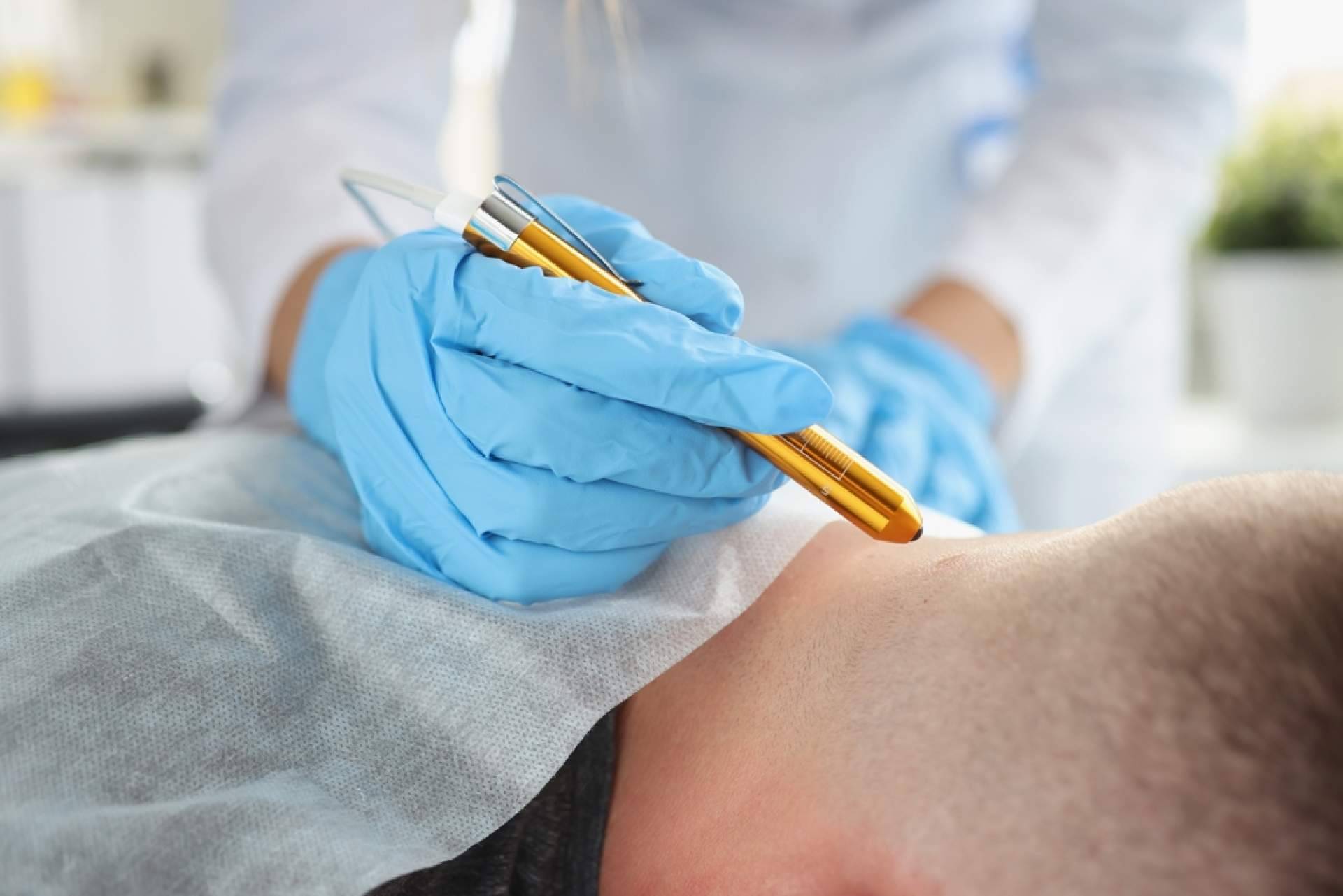 Centro Estética El Pilar ofrece soluciones avanzadas para la eliminación de lunares y verrugas sin cirugía