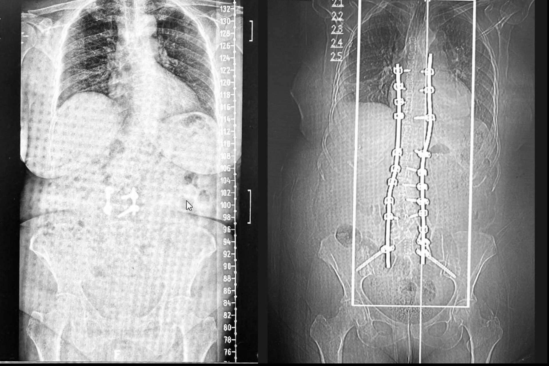 La revolución 3D en la cirugía de escoliosis en el adulto; entrevista con el Dr. Carlos Botella-Asunción