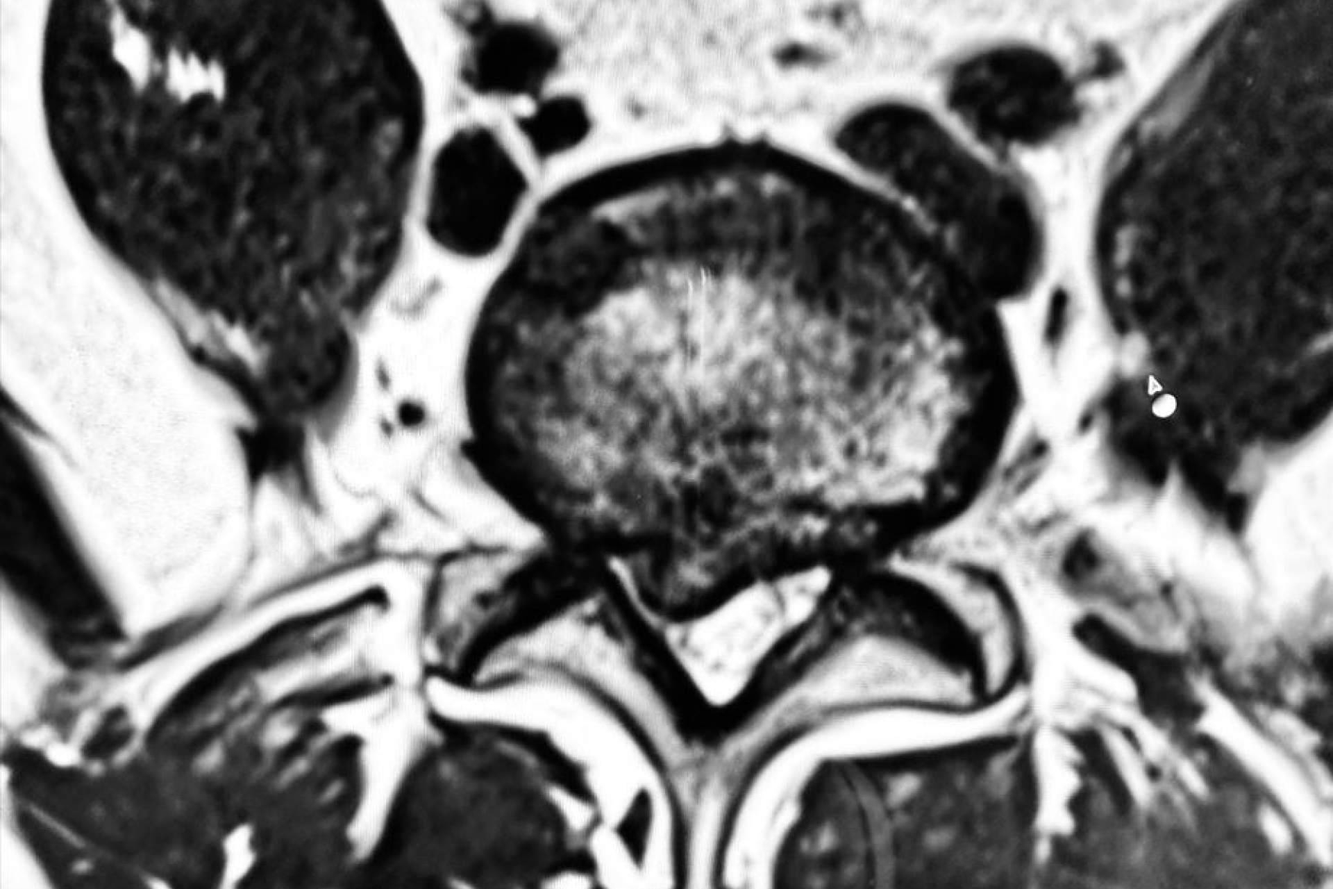 Entrevista al Dr. Botella-Asunción; Microdiscectomía vs. Discectomía endoscópica en la hernia discal lumbar