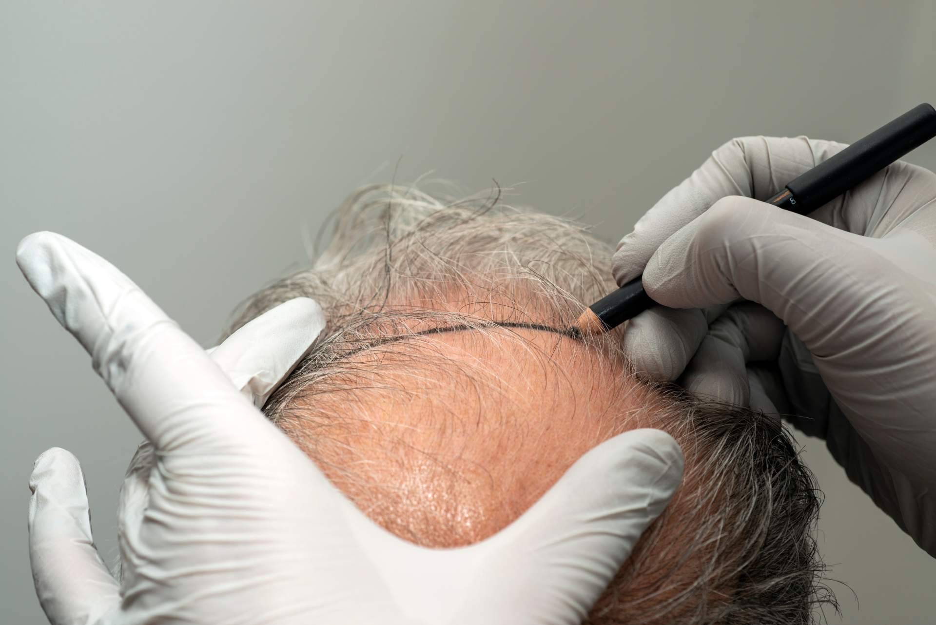 Dr. Jesús Aníbal Mora, especialista en trasplante capilar con enfoque personalizado y resultados naturales