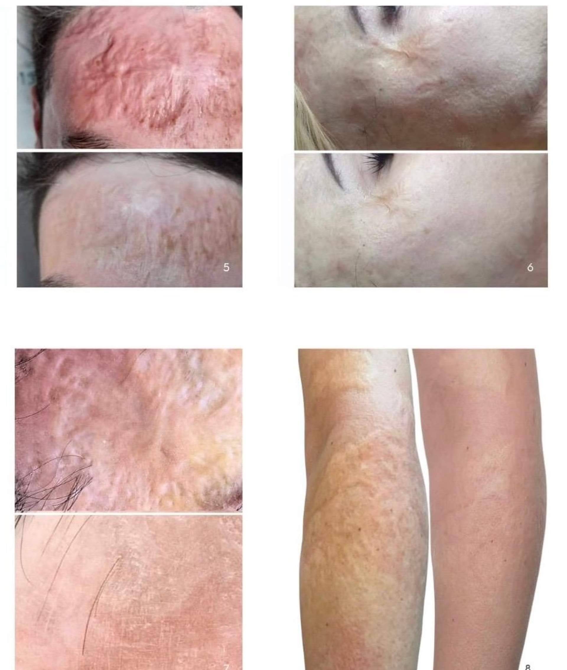 Cicatrices en Barcelona, soluciones avanzadas para marcas cutáneas en Cossbelt by Oksana