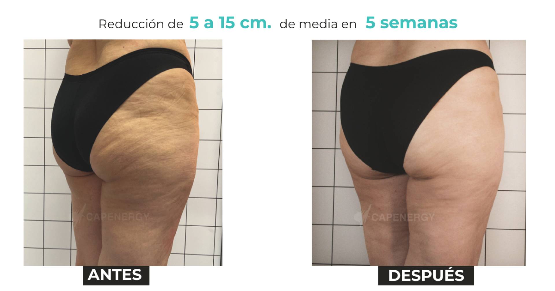 Capenergy C4.0 demuestra alta eficacia en celulitis con reducción de 14,8 cm