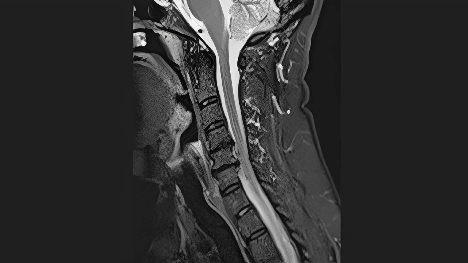 La cirugía endoscópica cervical abre nuevas posibilidades para muchos pacientes con hernias